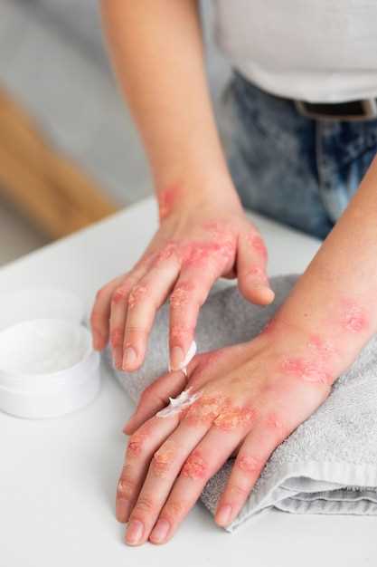 Amoxicillin rash complications